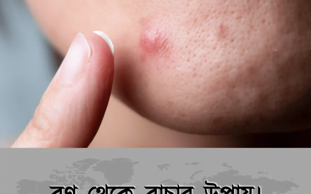 ব্রণ একটি পরিচিত সমস্যা